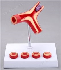 动脉硬化带血栓模型（Y型）